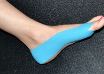 Tejpování – korekce hallux valgus