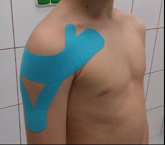 Tejpování – stabilizace ramenního kloubu